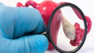 سرطان المبيض